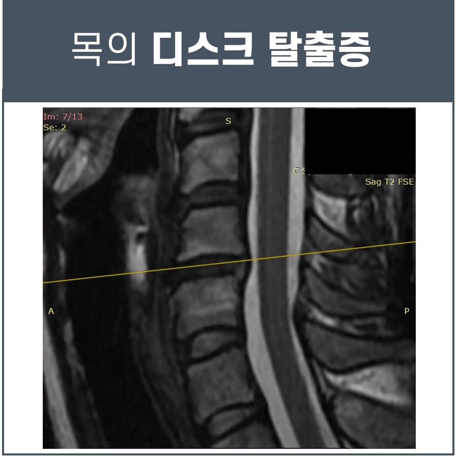 목 디스크 탈출증을 보여주는 경추 MRI 사진 — 서울 바로한의원 초음파 약침·도침