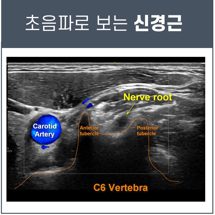 초음파로 촬영한 경동맥, 신경근, C6 척추의 모습 — 초음파 정밀 진단 | 서울 바로한의원 초음파 약침·도침·침도