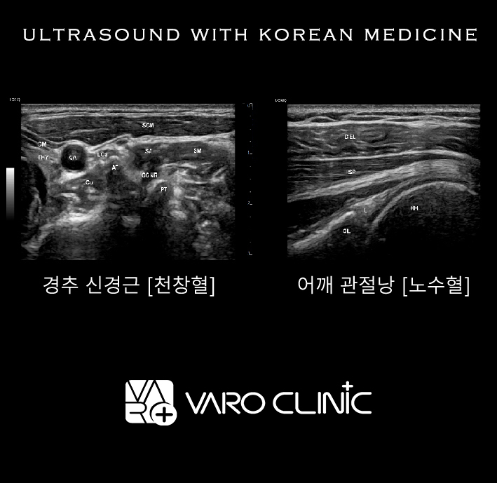 한의원에서 촬영한 경추 신경근과 어깨 관절낭 초음파 사진 — 초음파 정밀 진단 | 서울 바로한의원 초음파 약침·도침·침도