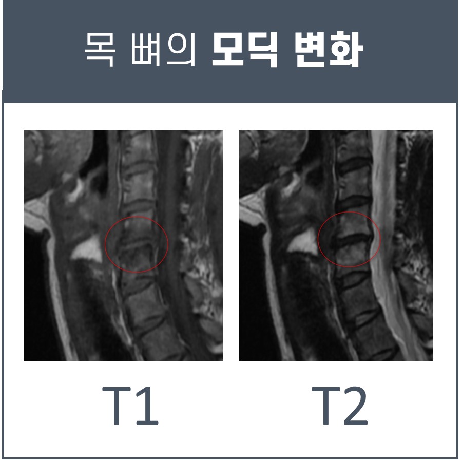 목뼈의 모딕 변화를 보여주는 T1, T2 MRI 영상 두 장. 빨간색 원으로 변화 부위가 표시되어 있다 — 서울 바로한의원 초음파 약침·도침