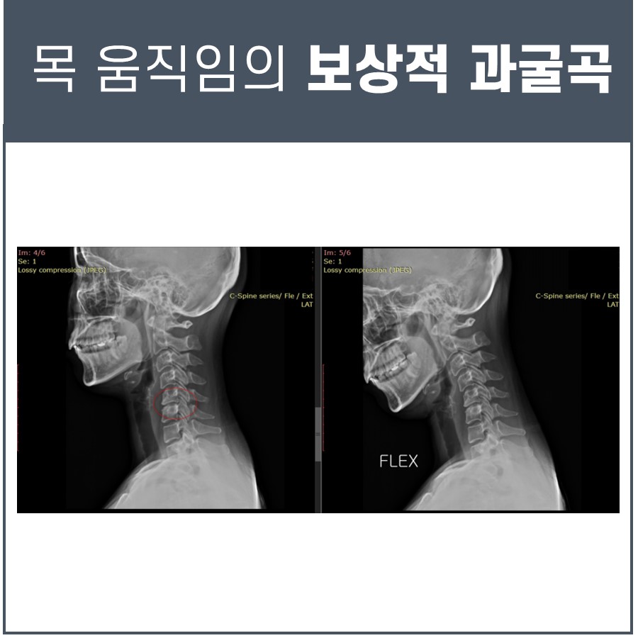 목 움직임의 보상적 과굴곡이라는 제목 아래, 경추 하단부를 붉은 원으로 표시한 왼쪽 경추 측면 엑스레이와 목을 굽힌(굴곡) 상태를 보여주는 오른쪽 경추 측면 엑스레이가 나란히 있다 — 서울 바로한의원 초음파 약침·도침