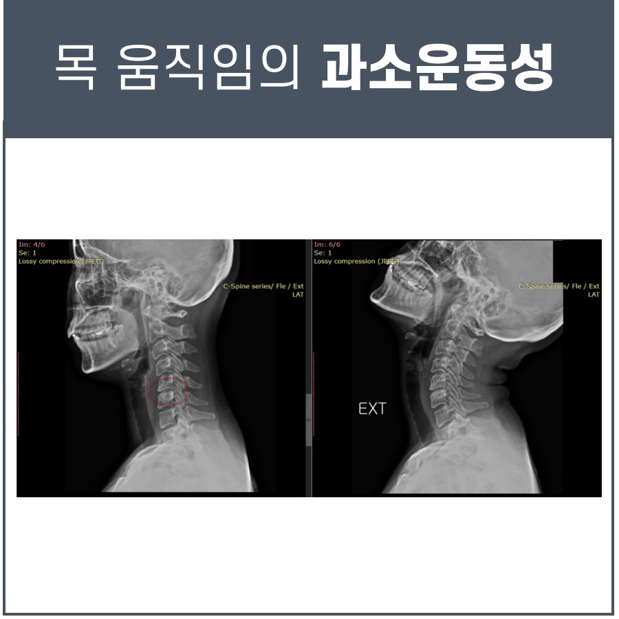 목 움직임의 과소운동성을 보여주는 경추 측면 X-ray 사진 두 장 — 서울 바로한의원 초음파 약침·도침