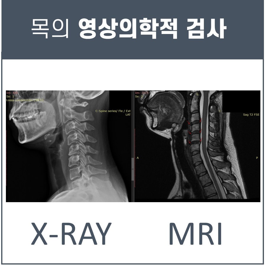 목 부위의 X-RAY와 MRI 영상 — 서울 바로한의원 초음파 약침·도침