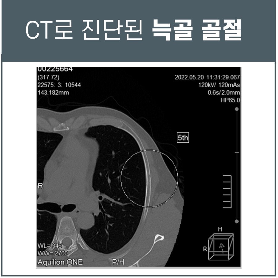 흉부 CT 영상에서 늑골 골절이 원으로 표시되어 있다 — 서울 바로한의원 초음파 약침·도침