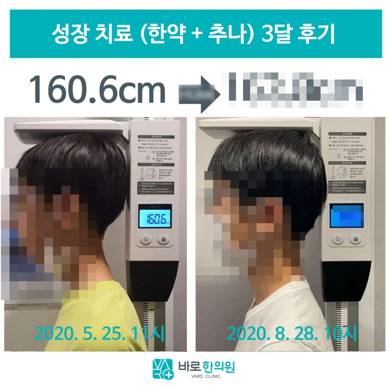키 측정 기계에 서 있는 아이의 성장 치료 전후 옆모습 비교 사진. 왼쪽에는 160.6cm가 표시되어 있다 — 서울 바로한의원 초음파 약침·도침