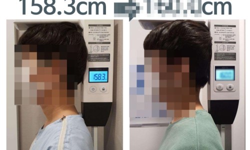 키 측정 기계로 키를 재는 사람의 모습. 왼쪽에는 158.3cm가 표시되어 있고, 오른쪽에는 흐릿하게 다른 키가 표시되어 있다 — 서울 바로한의원 초음파 약침·도침