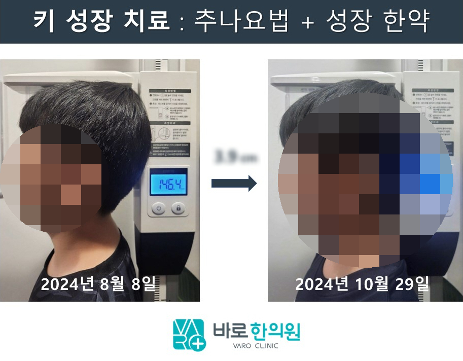 키 성장 치료 전후를 비교하는 사진으로, 2024년 8월 8일 146.4cm에서 2024년 10월 29일 3.9cm 성장한 아이의 모습 — 서울 바로한의원 초음파 약침·도침