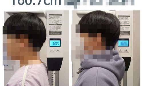 디지털 신장 측정기 옆에 서 있는 두 사람의 측면 모습. 한쪽 측정기 화면에는 160.7이라는 숫자가 보인다 — 서울 바로한의원 초음파 약침·도침