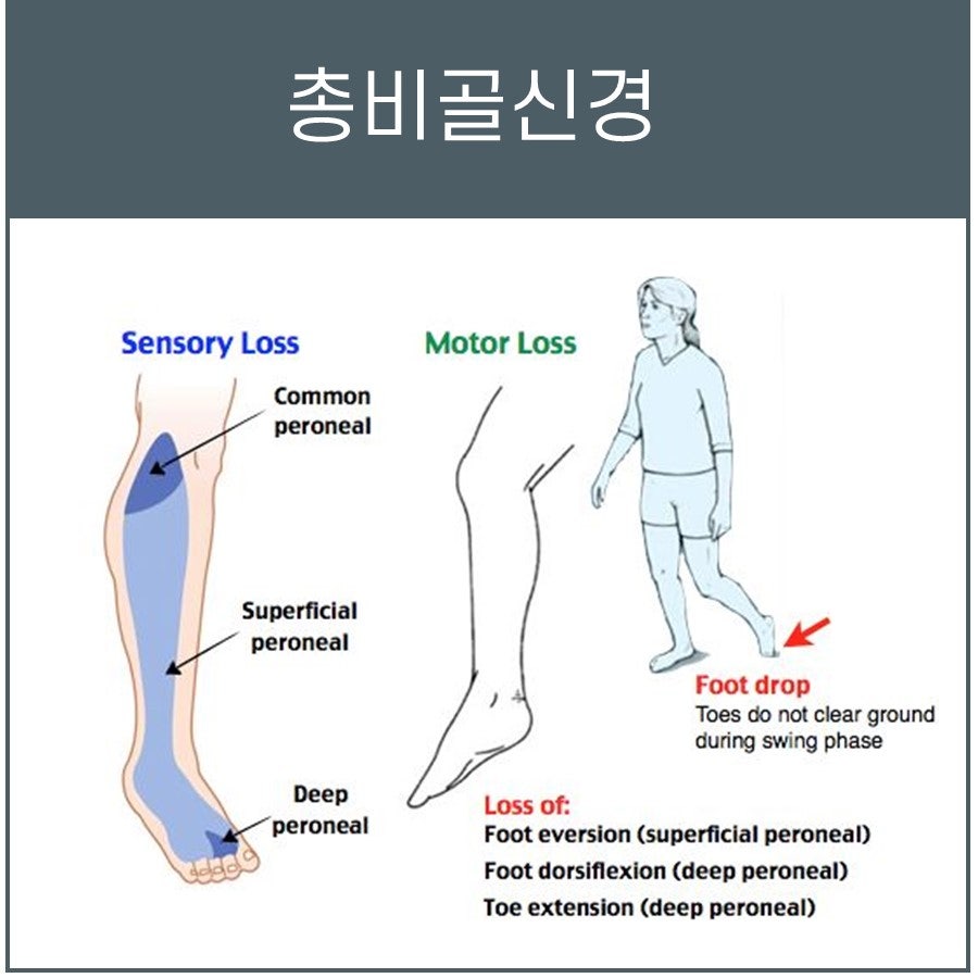총비골신경 마비로 인한 감각 손실 부위와 족하수 등 운동 손실 증상을 보여주는 그림 — 서울 바로한의원 초음파 약침·도침
