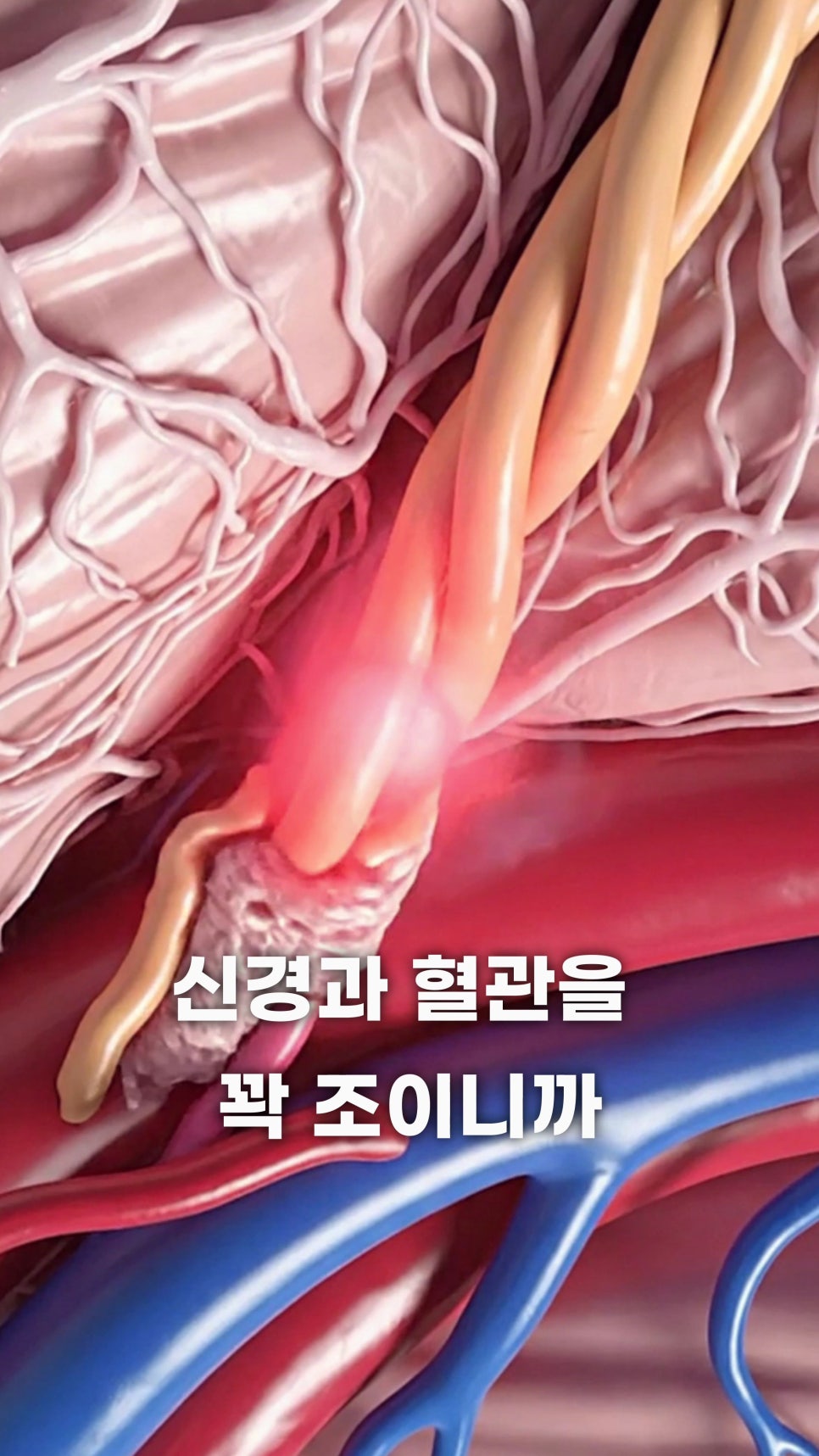 신경 다발과 혈관이 얽혀 있는 모습과 한 부분이 붉게 빛나며 압박받는 것을 보여주는 3D 이미지 — 서울 바로한의원 초음파 약침·도침