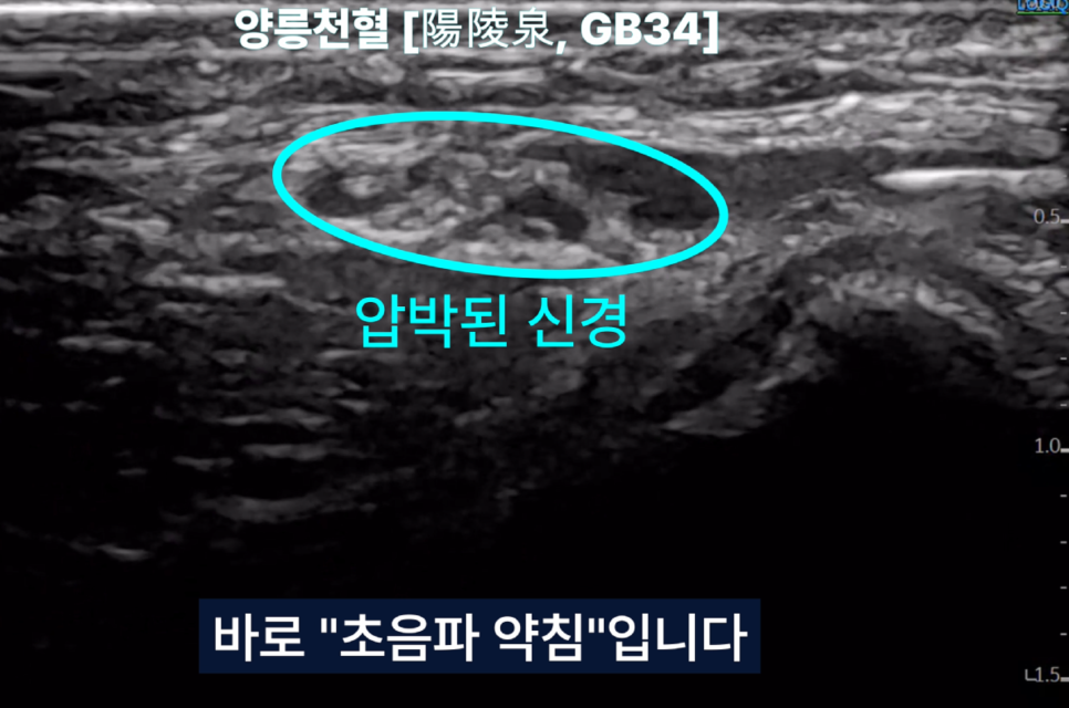 초음파 영상에서 양릉천혈 부위의 압박된 신경을 파란색 타원으로 표시한 모습 — 초음파 정밀 진단 | 서울 바로한의원 초음파 약침·도침·침도