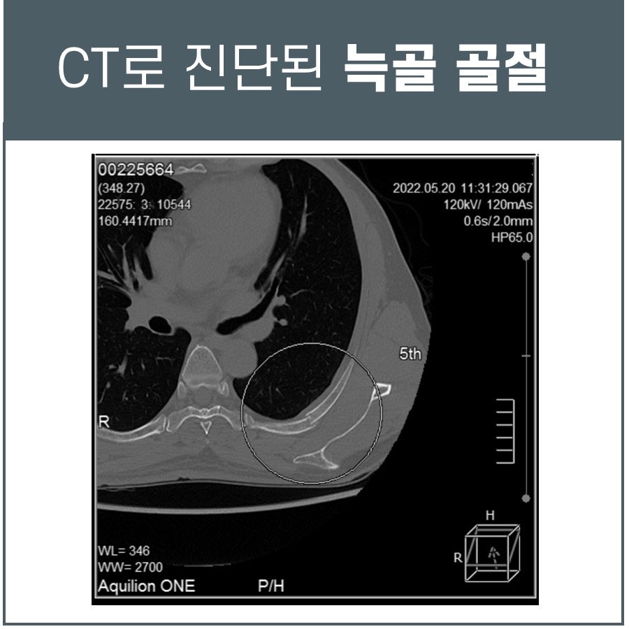 CT 영상에서 늑골 골절이 확인된 모습 — 서울 바로한의원 초음파 약침·도침