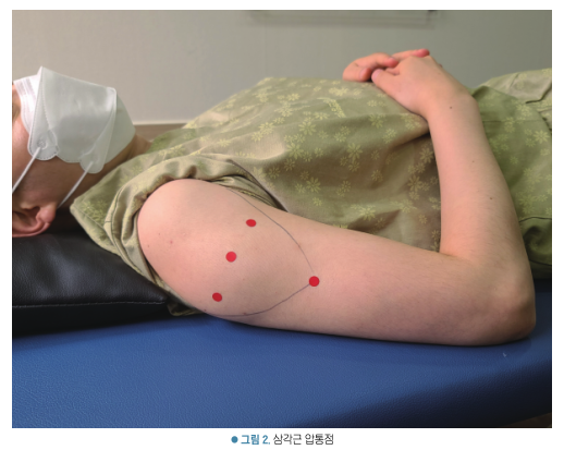 환자가 옆으로 누워 어깨와 팔에 삼각근 압통점이 표시된 모습 — 서울 바로한의원 초음파 약침·도침