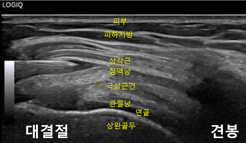 어깨 부위의 초음파 영상으로, 삼각근, 극상근건, 상완골두, 견봉 등 주요 해부학적 구조가 표시되어 있습니다 — 초음파 정밀 진단 | 서울 바로한의원 초음파 약침·도침·침도