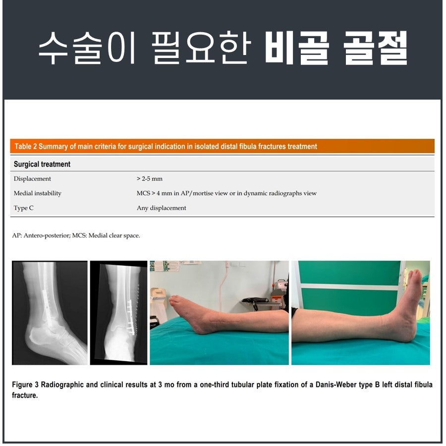비골 골절 수술 기준을 요약한 표와 수술 후 3개월이 지난 발목의 엑스레이 사진 및 임상 사진 — 서울 바로한의원 초음파 약침·도침