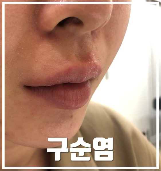 건조하고 각질이 일어난 입술과 입술 주변의 붉은 기 및 부어오름 — 서울 바로한의원 초음파 약침·도침