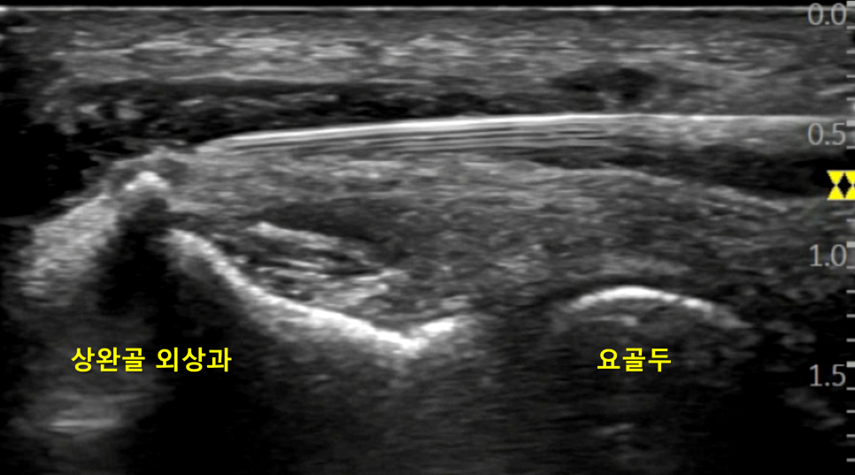 팔꿈치 관절에 침이 삽입된 경혈 초음파 이미지로, 상완골 외상과와 요골두가 표시되어 있습니다 — 초음파 유도하 약침 시술 | 서울 바로한의원