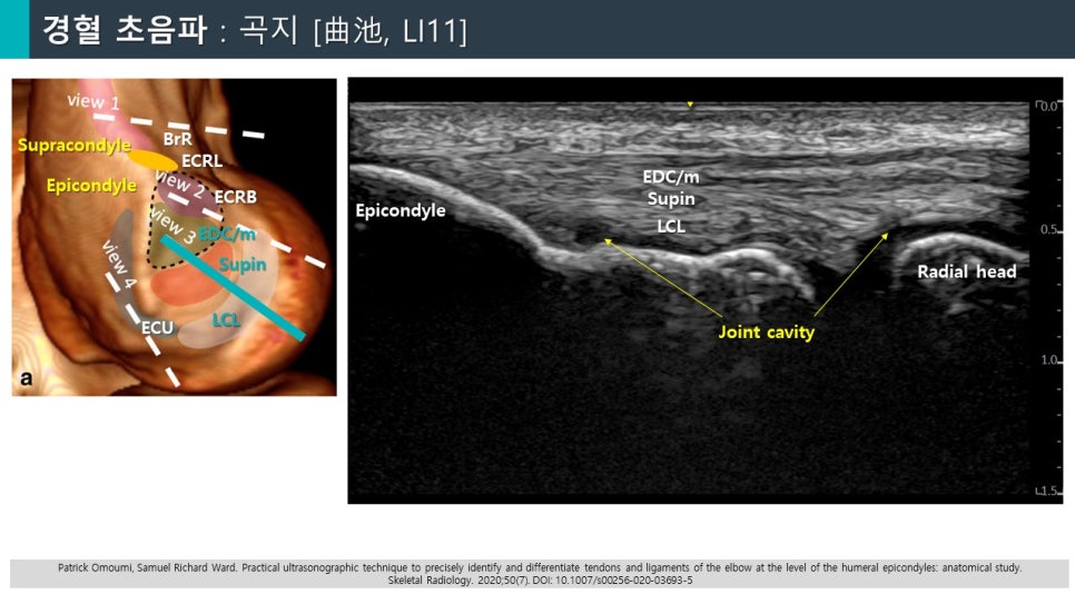 팔꿈치 바깥쪽의 해부학적 구조와 초음파 영상이 함께 나타난 이미지 — 초음파 정밀 진단 | 서울 바로한의원 초음파 약침·도침·침도