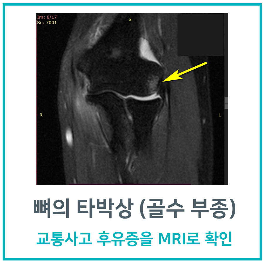 팔꿈치 관절 MRI 영상에서 뼈 타박상(골수 부종)이 노란색 화살표로 표시되어 있다 — 서울 바로한의원 초음파 약침·도침