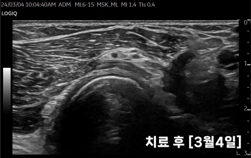 치료 후 팔꿈치 부위 내부 조직을 촬영한 초음파 영상 — 초음파 정밀 진단 | 서울 바로한의원 초음파 약침·도침·침도