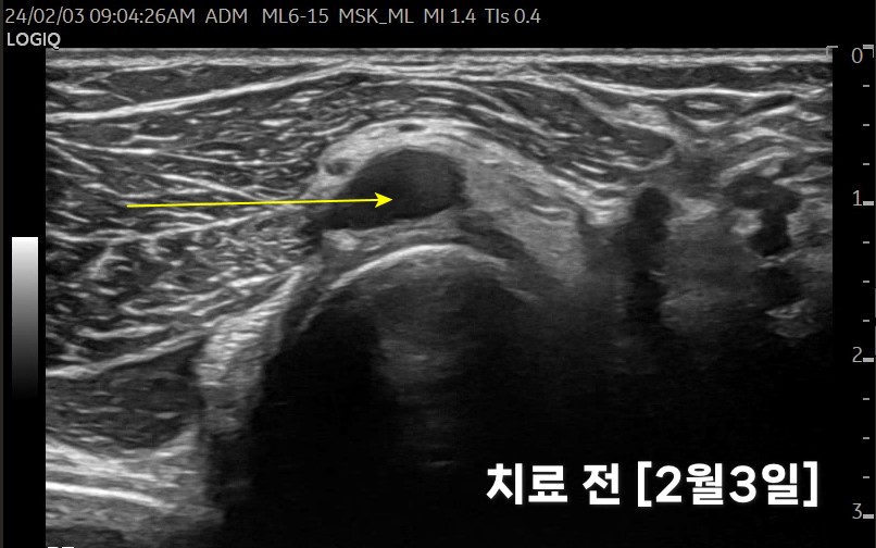 노란색 화살표로 가리킨 팔꿈치 부위의 물혹 초음파 사진. 하단에 '치료 전 [2월3일]' 문구가 있다 — 초음파 정밀 진단 | 서울 바로한의원 초음파 약침·도침·침도