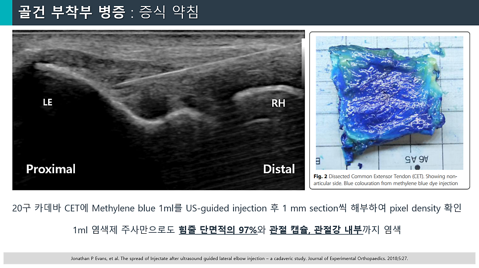 초음파 영상에서 팔꿈치에 주사 바늘이 삽입된 모습과 메틸렌 블루로 염색된 해부된 팔꿈치 힘줄 조직 — 초음파 유도하 약침 시술 | 서울 바로한의원
