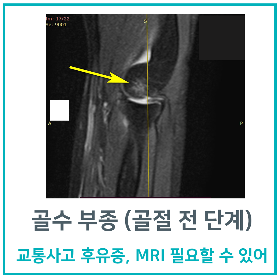 팔꿈치 MRI 영상에서 노란색 화살표가 골수 부종 부위를 가리키고 있습니다 — 서울 바로한의원 초음파 약침·도침