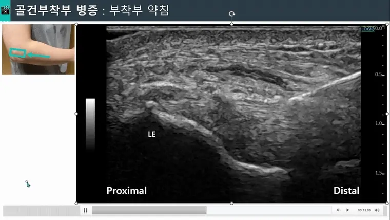 팔꿈치 부위에 약침 주입을 위해 초음파로 바늘을 확인하는 모습 — 초음파 유도하 약침 시술 | 서울 바로한의원