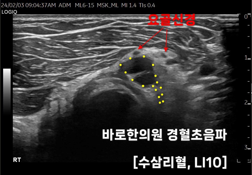 팔꿈치 부위 요골신경과 수삼리혈(LI10)을 표시한 초음파 사진 — 초음파 정밀 진단 | 서울 바로한의원 초음파 약침·도침·침도
