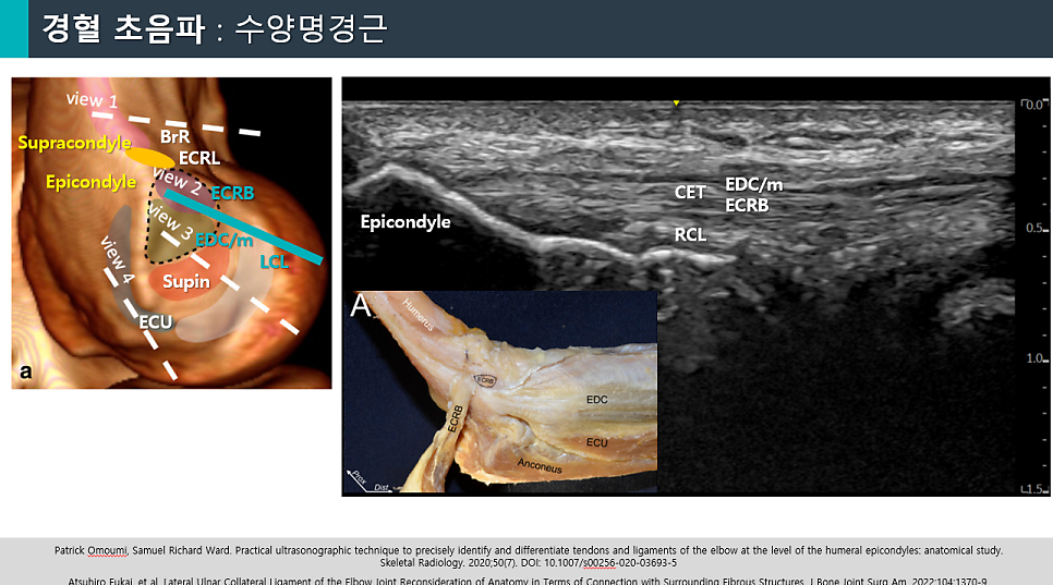 팔꿈치 바깥쪽 힘줄의 해부학적 구조와 초음파 영상 — 초음파 정밀 진단 | 서울 바로한의원 초음파 약침·도침·침도