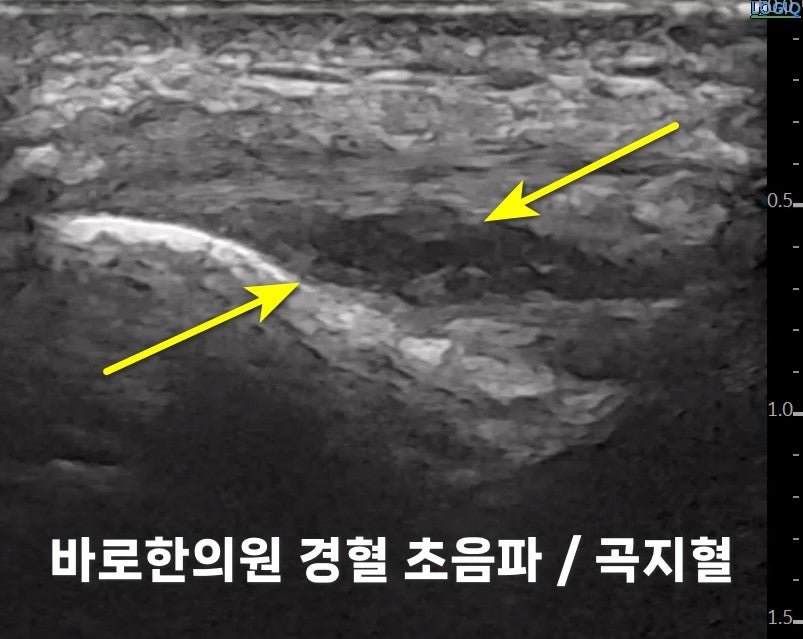 팔꿈치 부위의 초음파 사진으로, 두 개의 노란색 화살표가 내부 조직을 가리키고 있습니다 — 초음파 정밀 진단 | 서울 바로한의원 초음파 약침·도침·침도