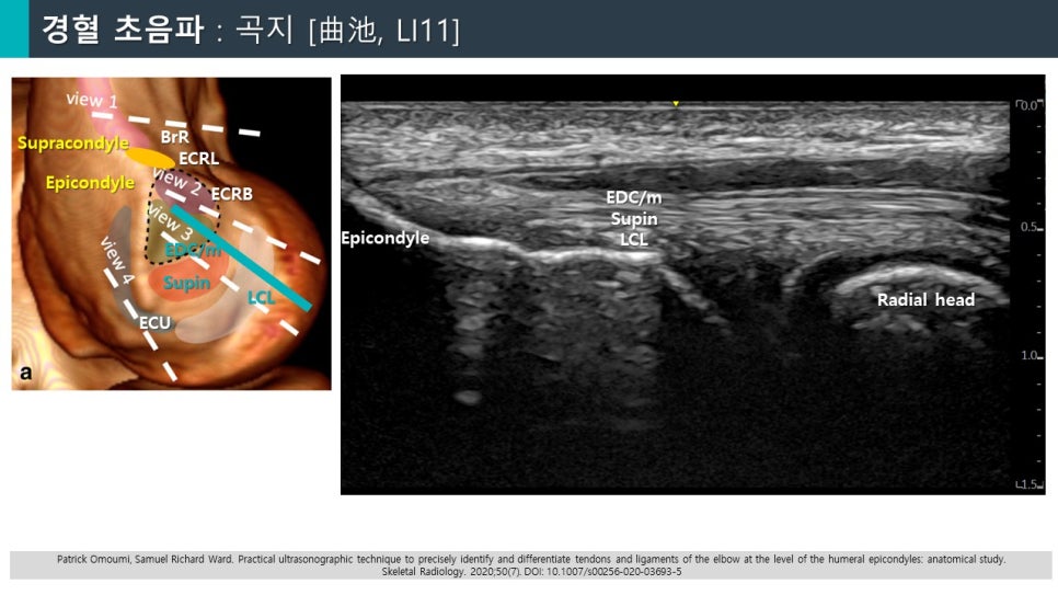 팔꿈치 바깥쪽의 해부학적 구조와 초음파 영상이 함께 제시된 이미지 — 초음파 정밀 진단 | 서울 바로한의원 초음파 약침·도침·침도