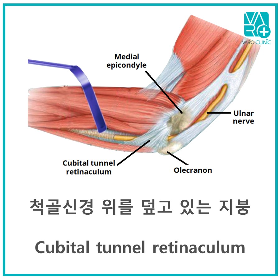 팔꿈치 척골신경과 팔꿈치터널 지붕인 척골신경포착대를 나타내는 해부학적 그림 — 서울 바로한의원 초음파 약침·도침