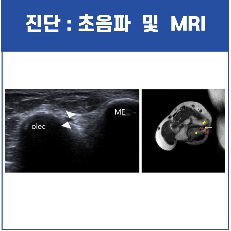 팔꿈치 척골 신경 마비 진단을 위한 초음파 및 MRI 영상 — 초음파 정밀 진단 | 서울 바로한의원 초음파 약침·도침·침도