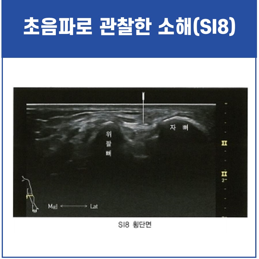 팔꿈치 관절의 위팔뼈와 자뼈를 보여주는 초음파 횡단면 이미지 — 초음파 정밀 진단 | 서울 바로한의원 초음파 약침·도침·침도