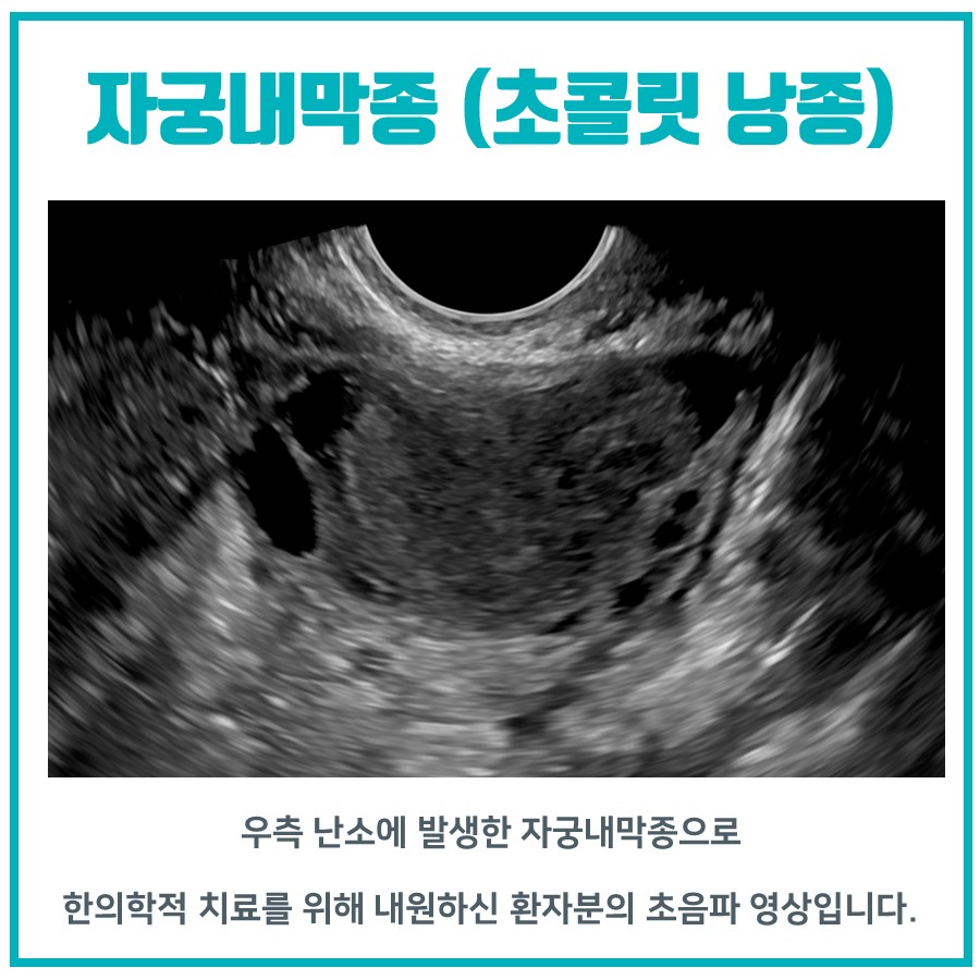 우측 난소에 발생한 자궁내막종의 초음파 영상입니다 — 초음파 정밀 진단 | 서울 바로한의원 초음파 약침·도침·침도