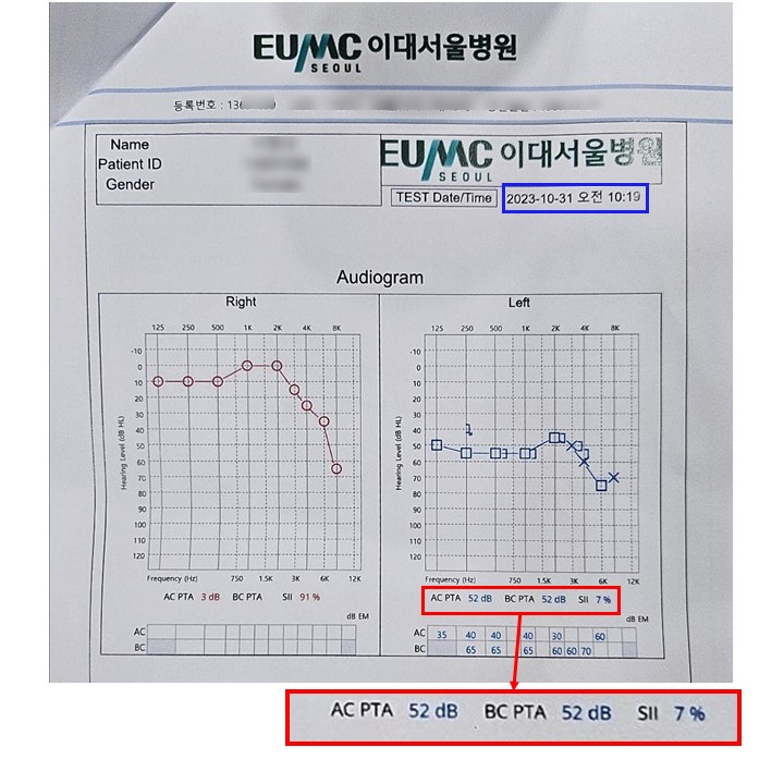 이대서울병원 청력검사 결과지 이미지로, 오른쪽과 왼쪽 귀의 주파수별 청력 수준 그래프와 함께 왼쪽 귀의 AC PTA, BC PTA, SII 수치가 표시되어 있다 — 서울 바로한의원 초음파 약침·도침