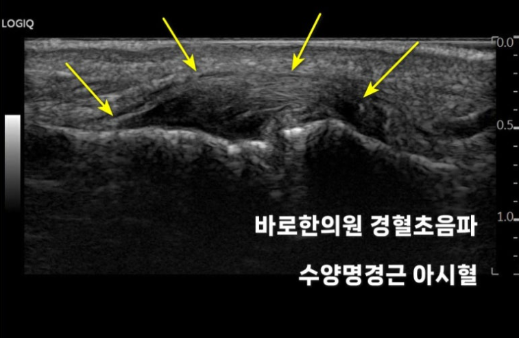 노란색 화살표로 특정 부위가 표시된 손가락 경혈 초음파 사진 — 초음파 정밀 진단 | 서울 바로한의원 초음파 약침·도침·침도