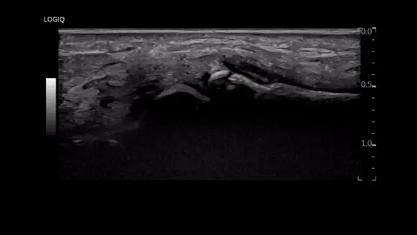 손가락 부위의 뼈와 연부조직을 나타내는 초음파 사진입니다 — 초음파 정밀 진단 | 서울 바로한의원 초음파 약침·도침·침도