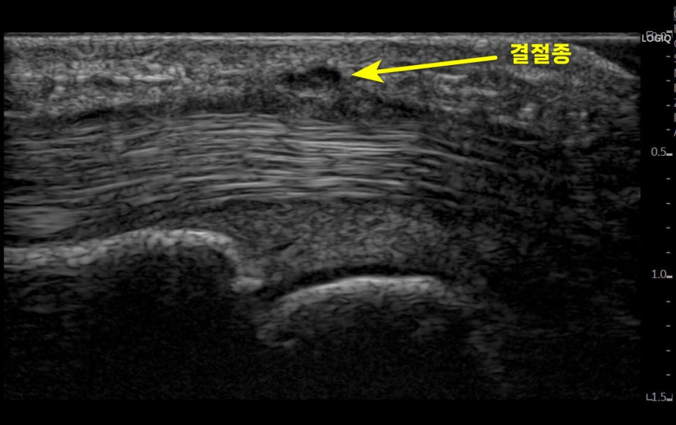 손가락 부위의 초음파 사진으로, 화살표가 가리키는 결절종이 보인다 — 초음파 정밀 진단 | 서울 바로한의원 초음파 약침·도침·침도