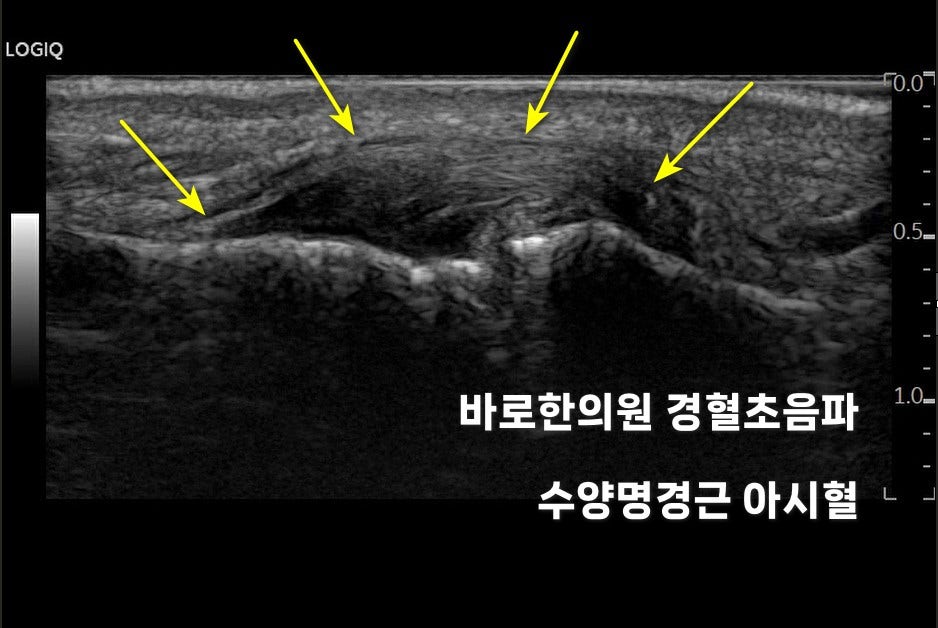손가락 인대 초음파 사진으로, 노란색 화살표가 인대 부위를 가리키고 있다 — 초음파 정밀 진단 | 서울 바로한의원 초음파 약침·도침·침도