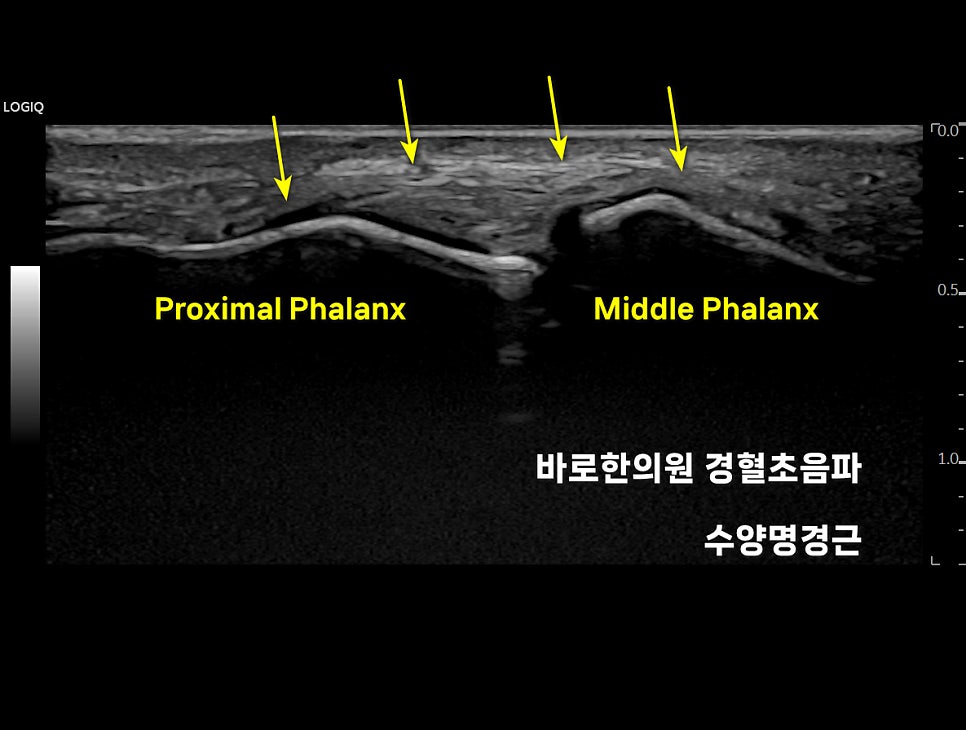 손가락 관절의 초음파 영상으로, 근위지골과 중위지골이 보이며 노란색 화살표가 인대 부위를 가리키고 있다 — 초음파 정밀 진단 | 서울 바로한의원 초음파 약침·도침·침도