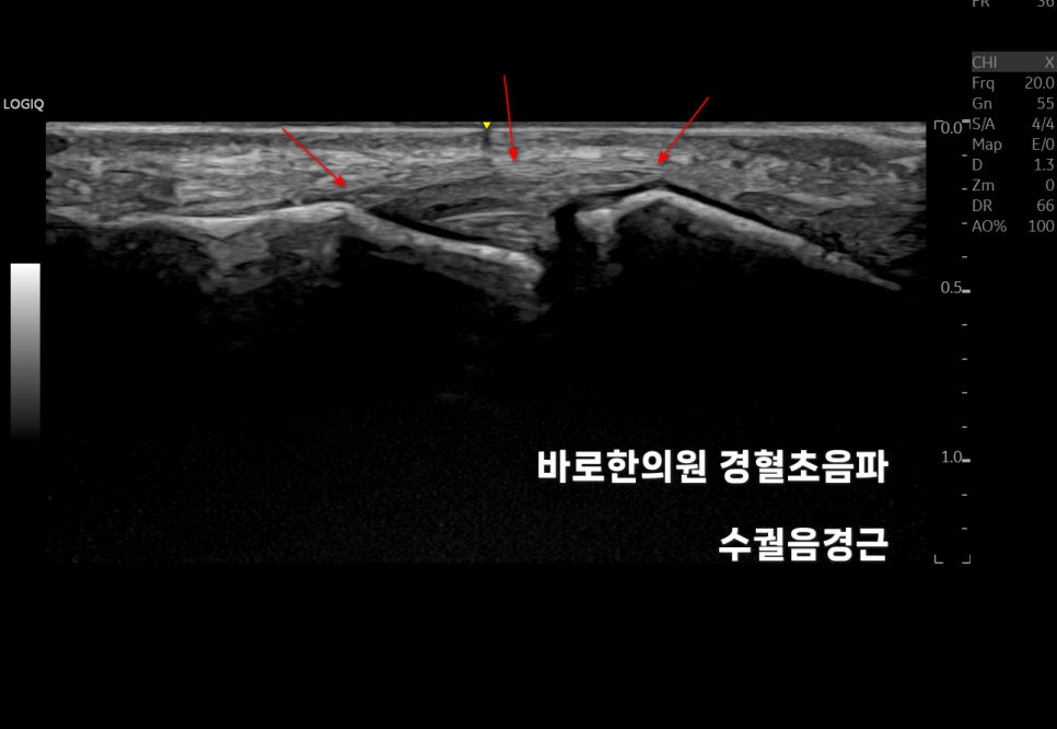 손가락 관절을 촬영한 초음파 이미지로, 붉은색 화살표가 특정 부위를 지시하고 있습니다 — 초음파 정밀 진단 | 서울 바로한의원 초음파 약침·도침·침도