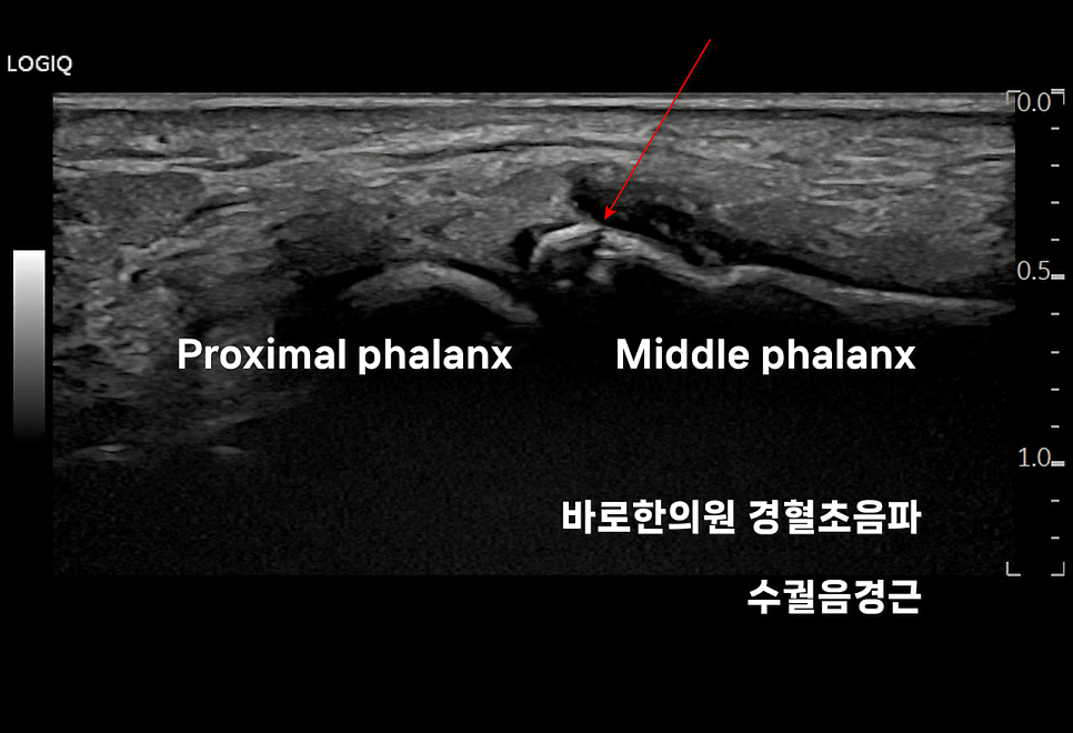 손가락 근위지골과 중위지골 사이의 초음파 영상으로, 붉은 화살표가 가리키는 부위에 골절이 보입니다 — 초음파 정밀 진단 | 서울 바로한의원 초음파 약침·도침·침도