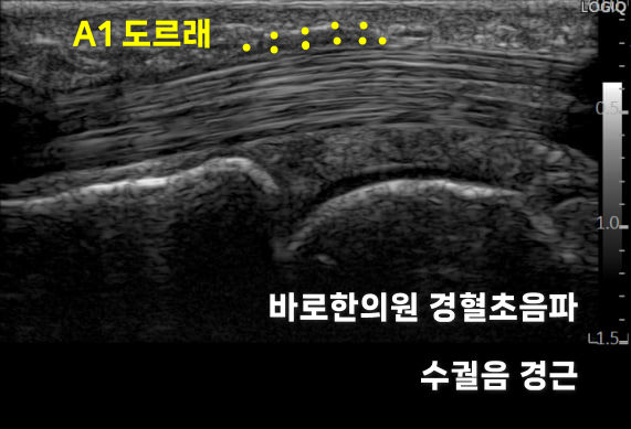 손가락 A1 도르래와 수궐음 경근 부위를 나타내는 초음파 사진 — 초음파 정밀 진단 | 서울 바로한의원 초음파 약침·도침·침도