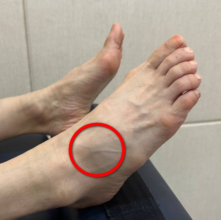 발등에 붉은 원으로 표시된 돌출된 부분이 있는 발 사진 — 서울 바로한의원 초음파 약침·도침