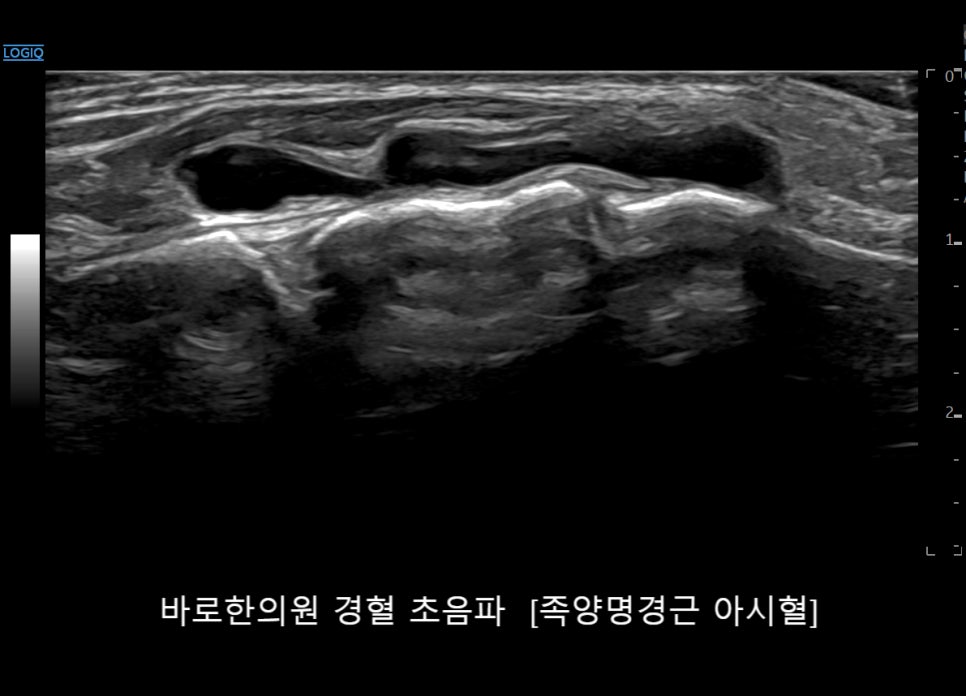 발등 부위의 초음파 영상으로, 액체로 채워진 것으로 보이는 구조물이 보인다 — 초음파 정밀 진단 | 서울 바로한의원 초음파 약침·도침·침도