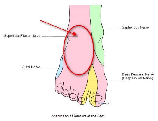 발등의 신경 분포를 보여주는 그림으로, 얕은종아리신경(Superficial Fibular Nerve)이 분포하는 영역이 빨간색 타원으로 표시되어 있습니다 — 서울 바로한의원 초음파 약침·도침