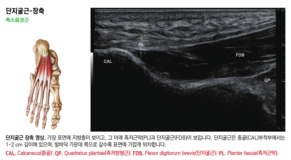 발 해부학 그림과 발바닥 초음파 영상으로, 초음파 영상에는 종골, 족저근막, 단지굴근이 표시되어 있다 — 초음파 정밀 진단 | 서울 바로한의원 초음파 약침·도침·침도