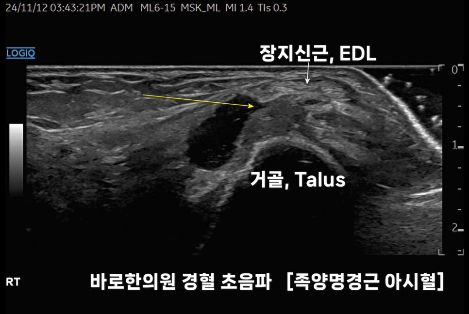 초음파로 확인한 발목 결절종과 점액낭염 감별진단